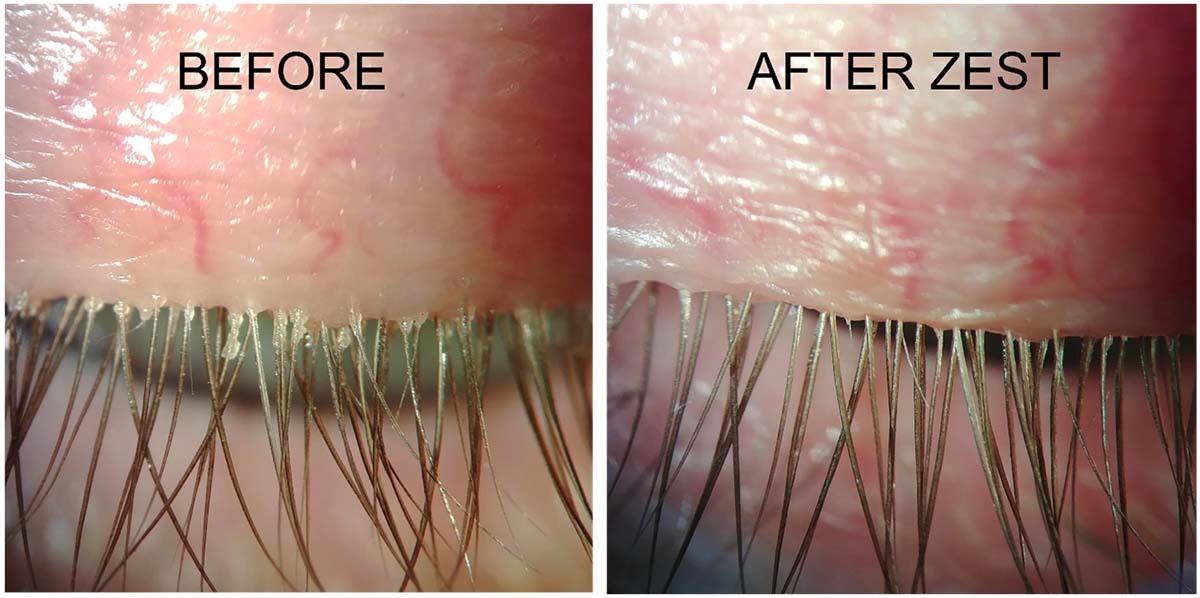 Before and after ZEST